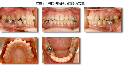 写真１・当院初診時の口腔内写真