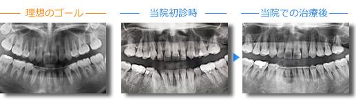 歯の根は平行に並んでいるか？