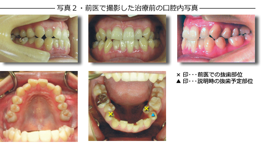 写真２・前医で撮影した治療前の口腔内写真