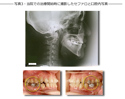 写真3・党員での治療開始時に撮影したせふぁろと口腔内写真