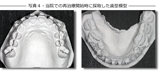 写真４・当院での再治療開始時に採取した歯型模型