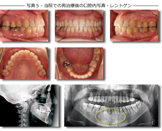 写真５・当院での再治療後の口腔内写真・レントゲン