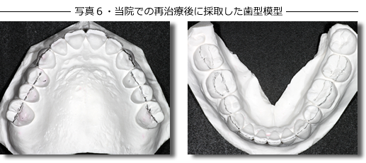 写真６・当院での再治療後に採取した歯型模型