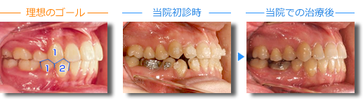 かみ合わせが緊密になっているか？