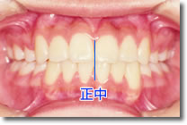 前歯の中心が揃っている