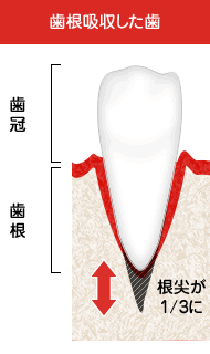 矯正の副作用歯根吸収